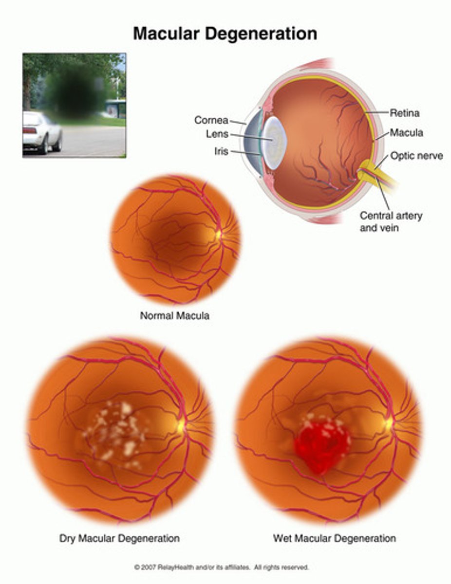 <p>Large soft drusen and new blood vessels (neovascularization) beneath the retina are seen, which may leak blood and fluid.</p>