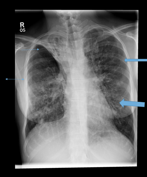 <p>sign on chest imaging indicative of bronchiectasis, characterized by parallel lines representing thickened bronchial walls. </p>