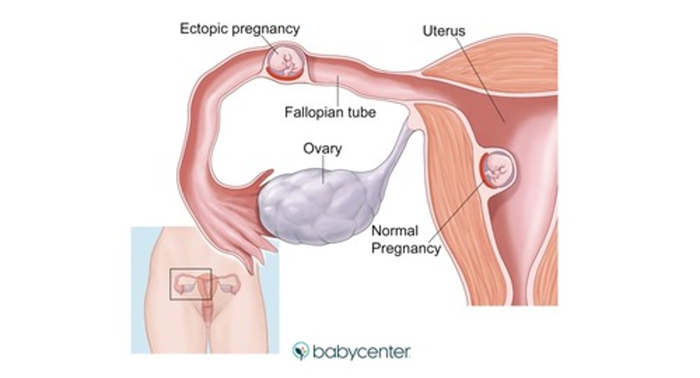 <p>intrauterine pregnancy + ectopic pregnancy</p><p>- very rare, but technically possible even when IUP is confirmed</p>