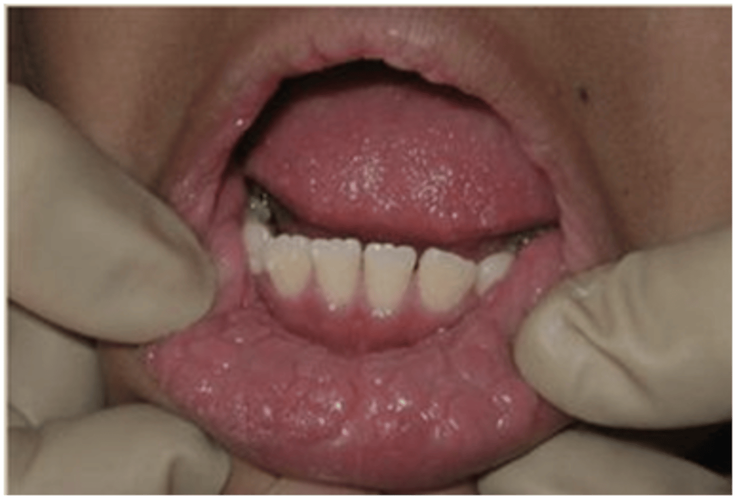 <p>AKA Multifocal Epithelial Hyperplasia</p><p>• multiple, soft, flattened nodules</p><p>• pink or white</p><p>• associated with HPV </p><p>• common location: mucosa</p><p>• population: Children (seen in Indians)</p>