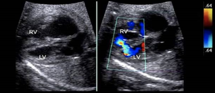 <p>what is this cardiac defect</p><p>a) patent foramen ovale</p><p>b) aortopulmonary window</p><p>c) sinus venosus ASD</p><p>d) muscular VSD</p>