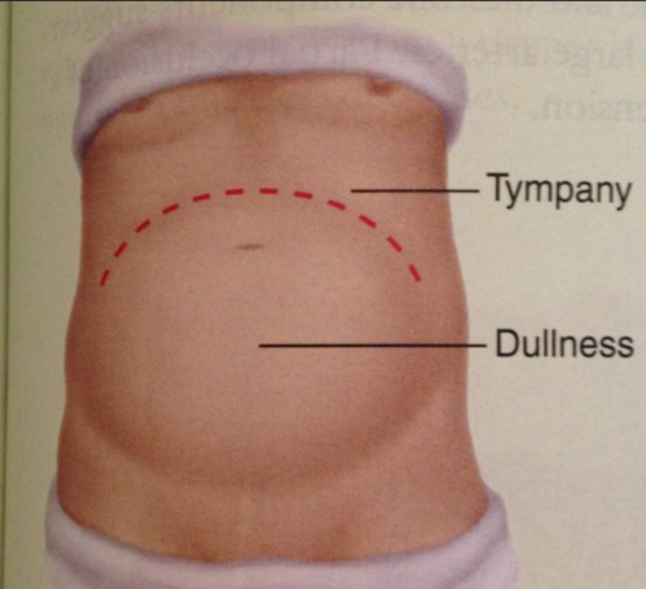 <p>A</p><p>Ascites is free fluid in the peritoneal cavity and occurs with heart failure, portal hypertension, cirrhosis, hepatitis, pancreatitis, and cancer</p>