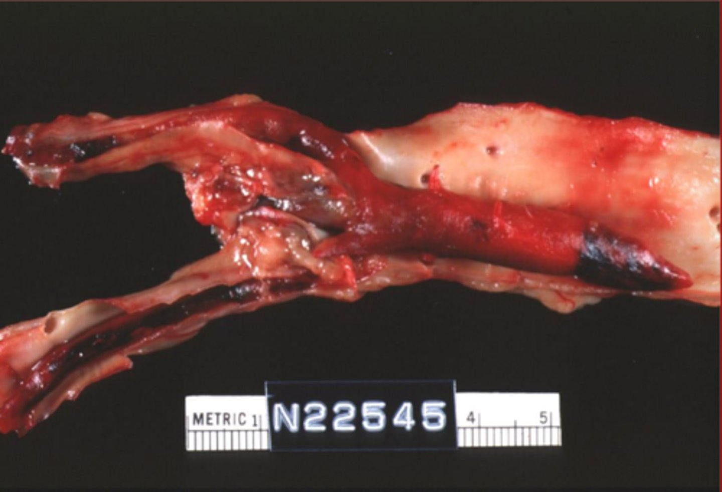 <p>arterial or veinous thrombi?</p>