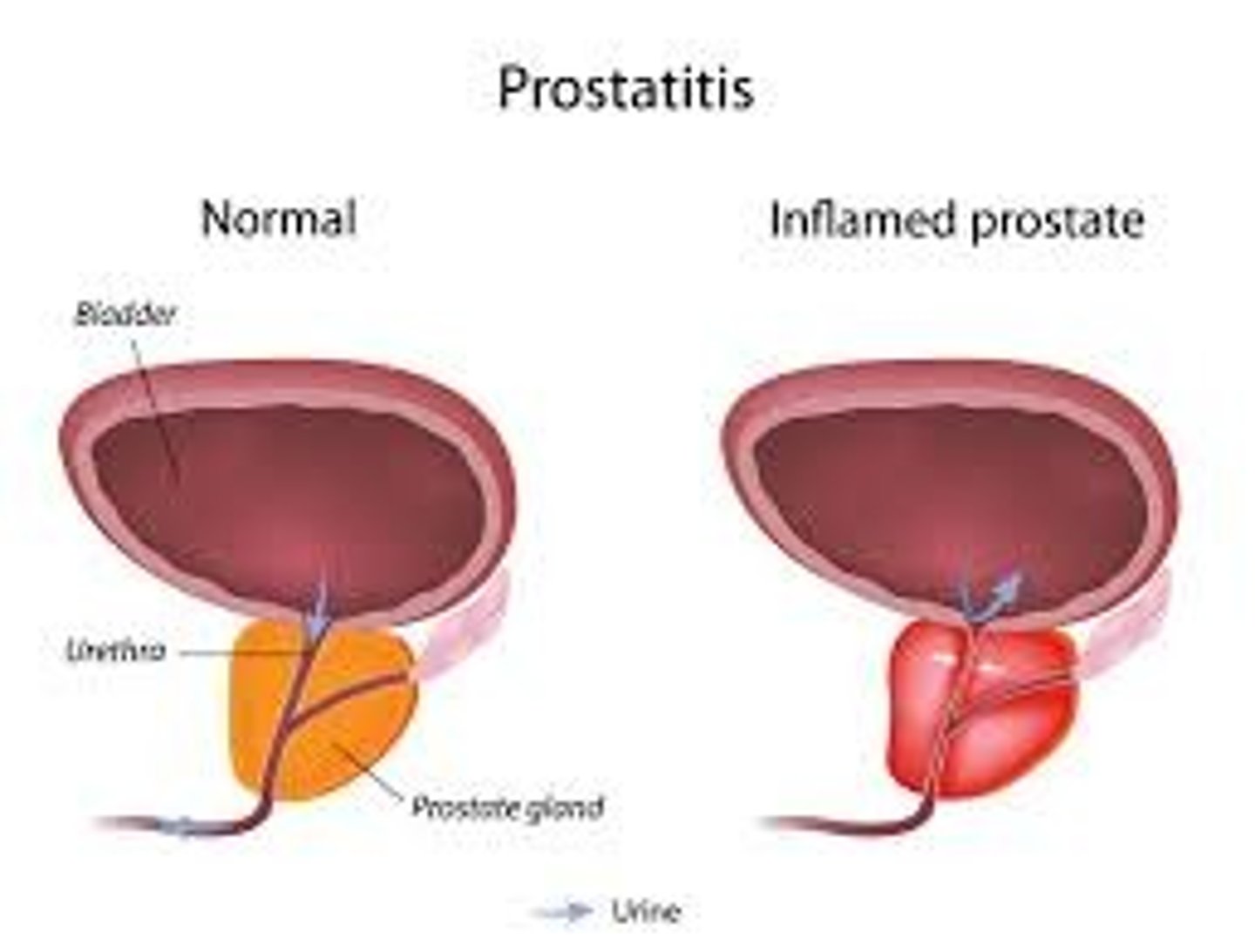 <p>Inflammation of prostate gland due to bacterial infection, or back up of prostate secretions in the gland.</p><p>I. Acute Bacterial</p><p>II. Chronic Bacterial</p><p>III. Chronic Pelvic Pain Syndrome</p><p>IV. Asymptomatic Inflammatory Prostatitis</p><p>Sxs: Urgency, frequency, discomfort with urination and pain with ejaculation.</p><p>-Chronic pelvic pain syndrome--pain in perineum, rectum, prostate, penis, testicles, abdomen.</p><p>-Asymptomatic inflammatory prostatitis--prostate inflammation in absence of genitourinary tract symptoms</p>
