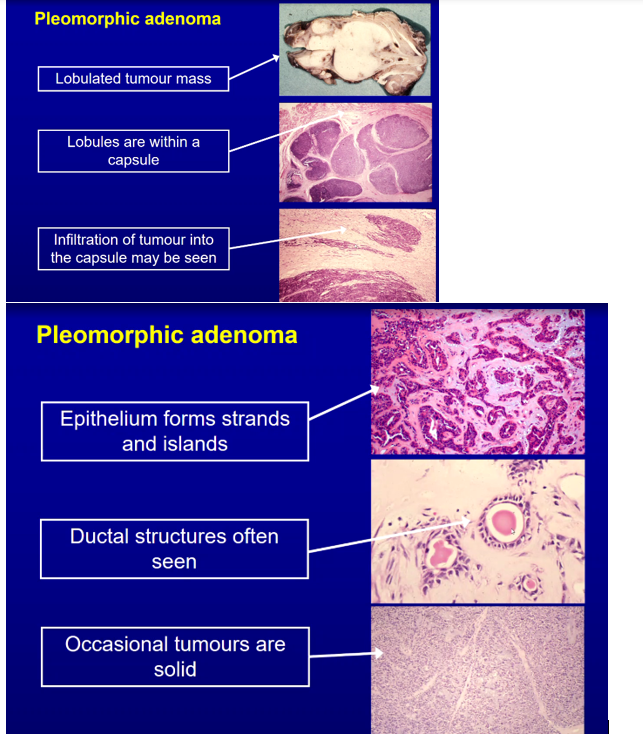 <p><span>Mixed Pleomorphic Pattern with Islands and Strands of Epithelial Cells</span><br><br><span>Ductal Structures are common</span><br><br><span>Tumour tends to be multi-lobular but encapsulated</span><br><br><span>Stroma can be Myxoid, Mucoid or Chondroid</span><br><br><span>Occasionally the tumours are solid</span></p>
