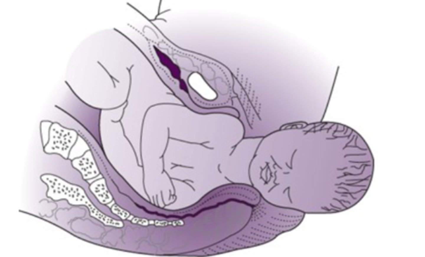 <p>-passive rotation of the fetal head back to anatomical position</p><p>-anterior shoulder rotates under the symphysis pubis</p>