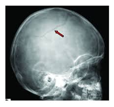 usually in flat bones, a break in the bone, but it does not move the bone
