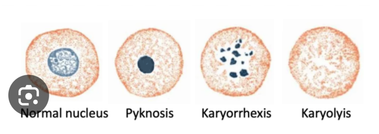 <ul><li><p>pyknosis</p></li><li><p>karyorexis</p></li><li><p>karyolysis</p></li></ul><p></p>