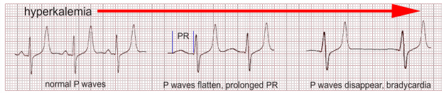 <p>What does this EKG show?</p><p>-Peaked T waves</p>