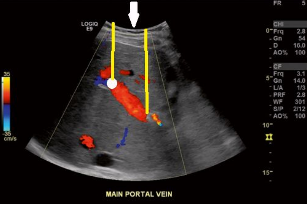 <p>where is the color detector/transducer in a blunted sector abdominal image?</p>