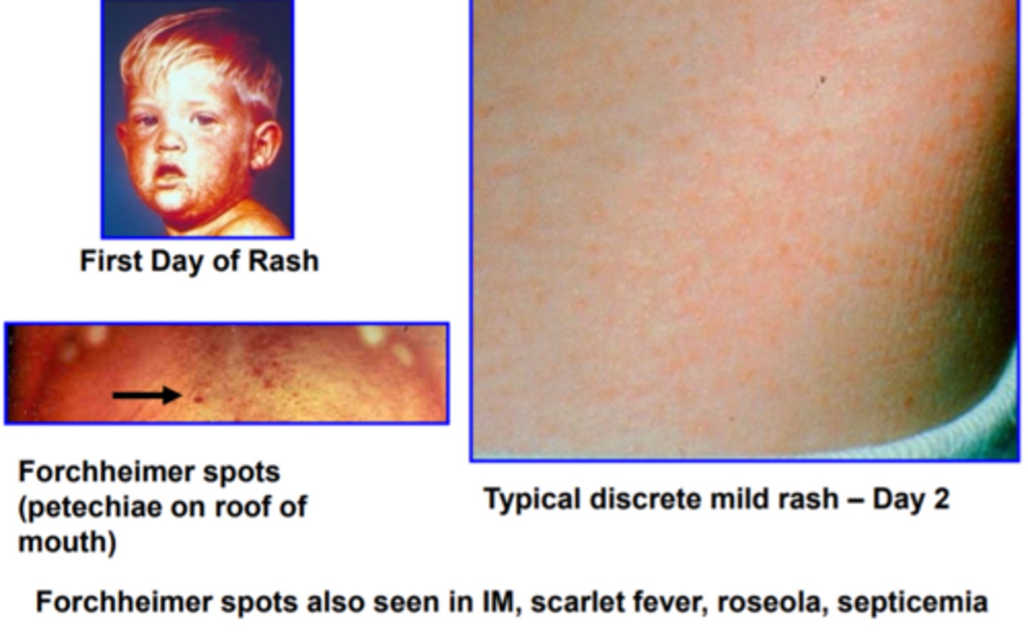 <p>Pink rash starts on face and spreads to chest and limbs, joint pain</p><p>Droplet Precautions for a week</p>