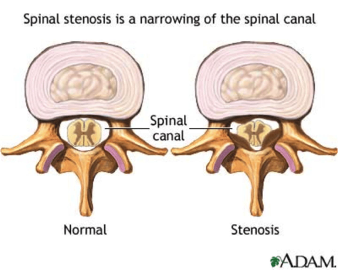 <p>narrowing of the lumbar spinal canal</p><p>*common in elderly (degenerative)</p><p>STRUCTURES INVOLVED:</p><p>- bone hypertrophy</p><p>- ligamentum flavum buckles</p><p>- enlargement of inferior facets</p><p>- osteophytes</p><p>*BILATERAL SYMPTOMS*</p>