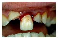 <p><span style="background-color: transparent;"><span>Axial displacement partially out of the socket</span></span></p><p><span style="background-color: transparent;"><span>Mobile tooth, looks elongated</span></span></p>