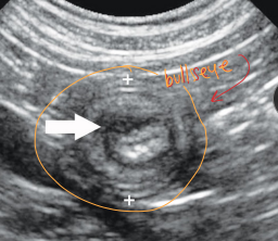 <p><span style="background-color: transparent;"><strong><span>Intussusception</span></strong></span></p>