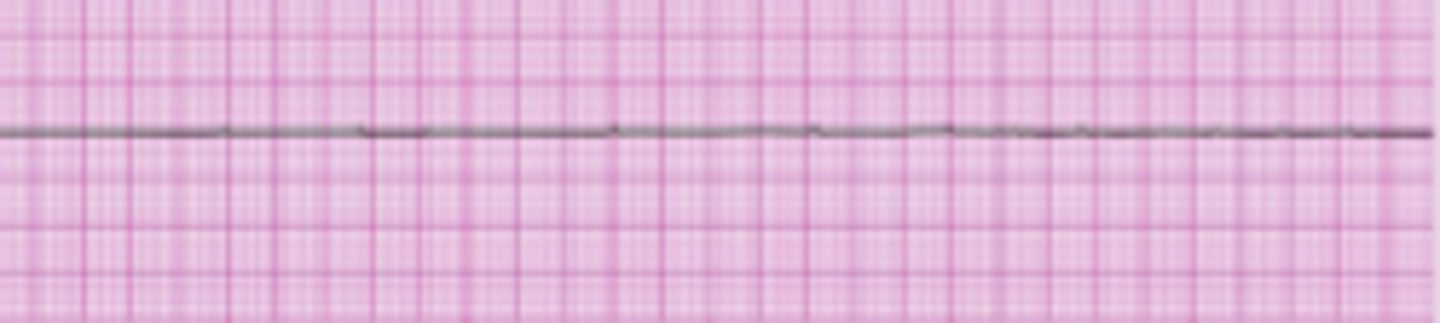 <p>- The complete absence of electrical and mechanical activity</p><p>- Cardiac output stops, and the blood pressure falls to zero. </p><p>- The ECG tracing appears as a flat line</p><p>- Treatment: CPR and ACLS</p>