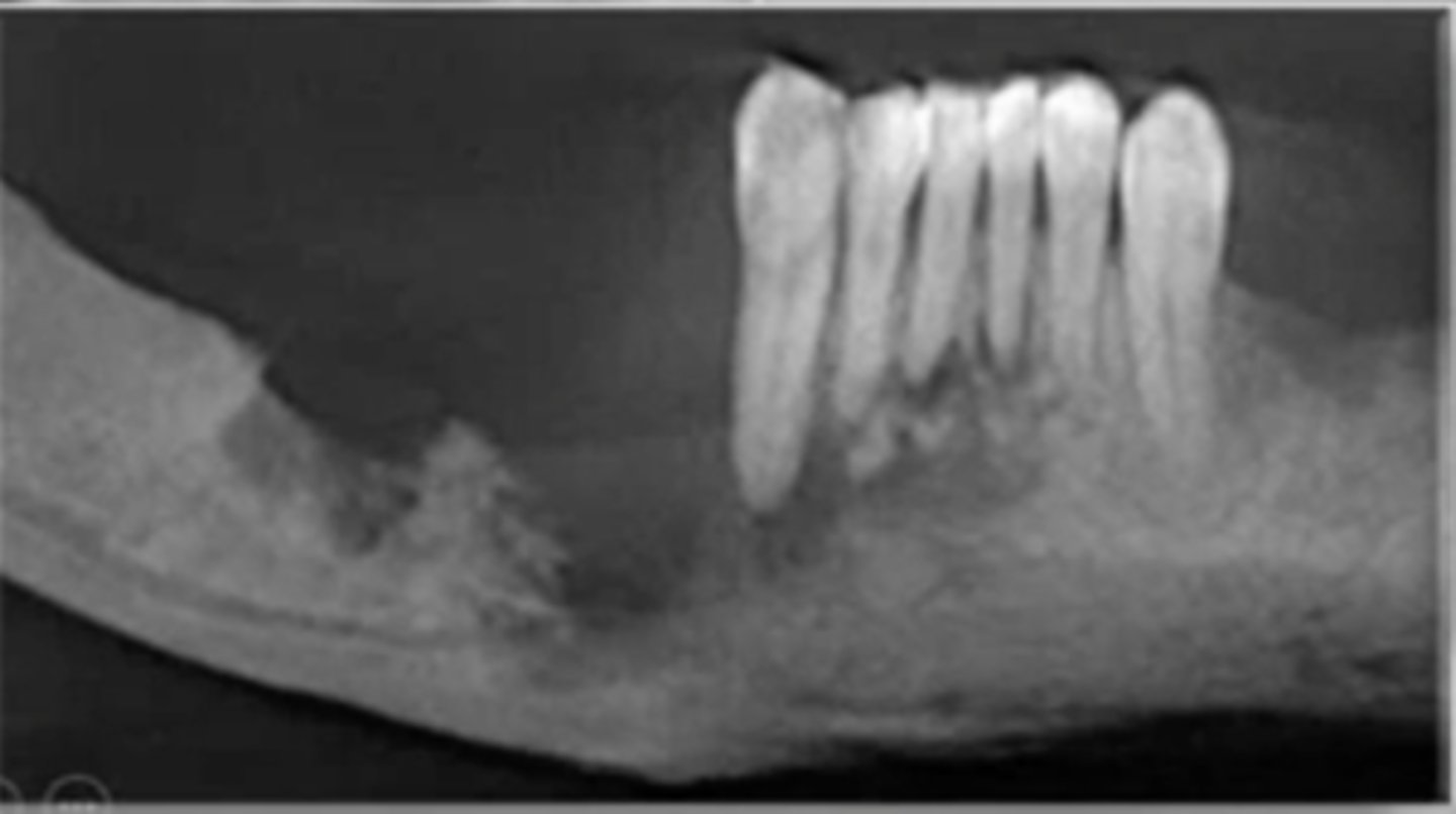 <p>moth-eaten, bone expansion cancer found on the gingiva and posterior mandible</p><p>• population: older adults (60-70s)</p>