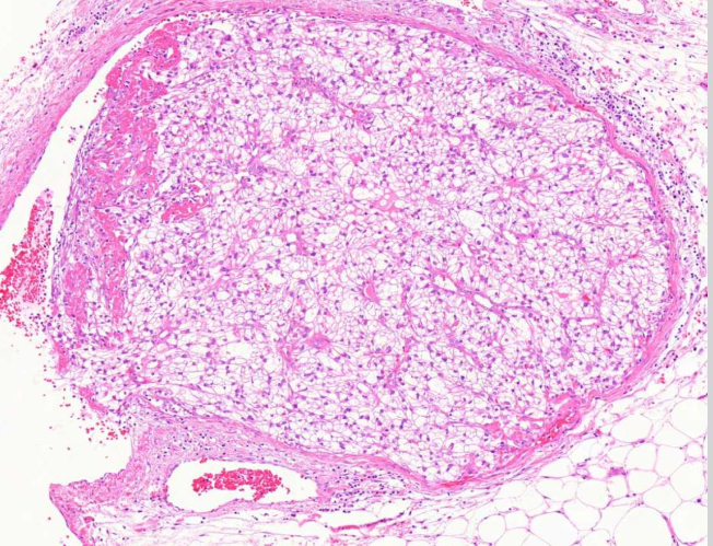 <p><strong><u>MIKÄ TAUTI?</u></strong> Kasvaimen vaskulaari-invaasiota perirenaalisessa rasvakudoksessa.</p>