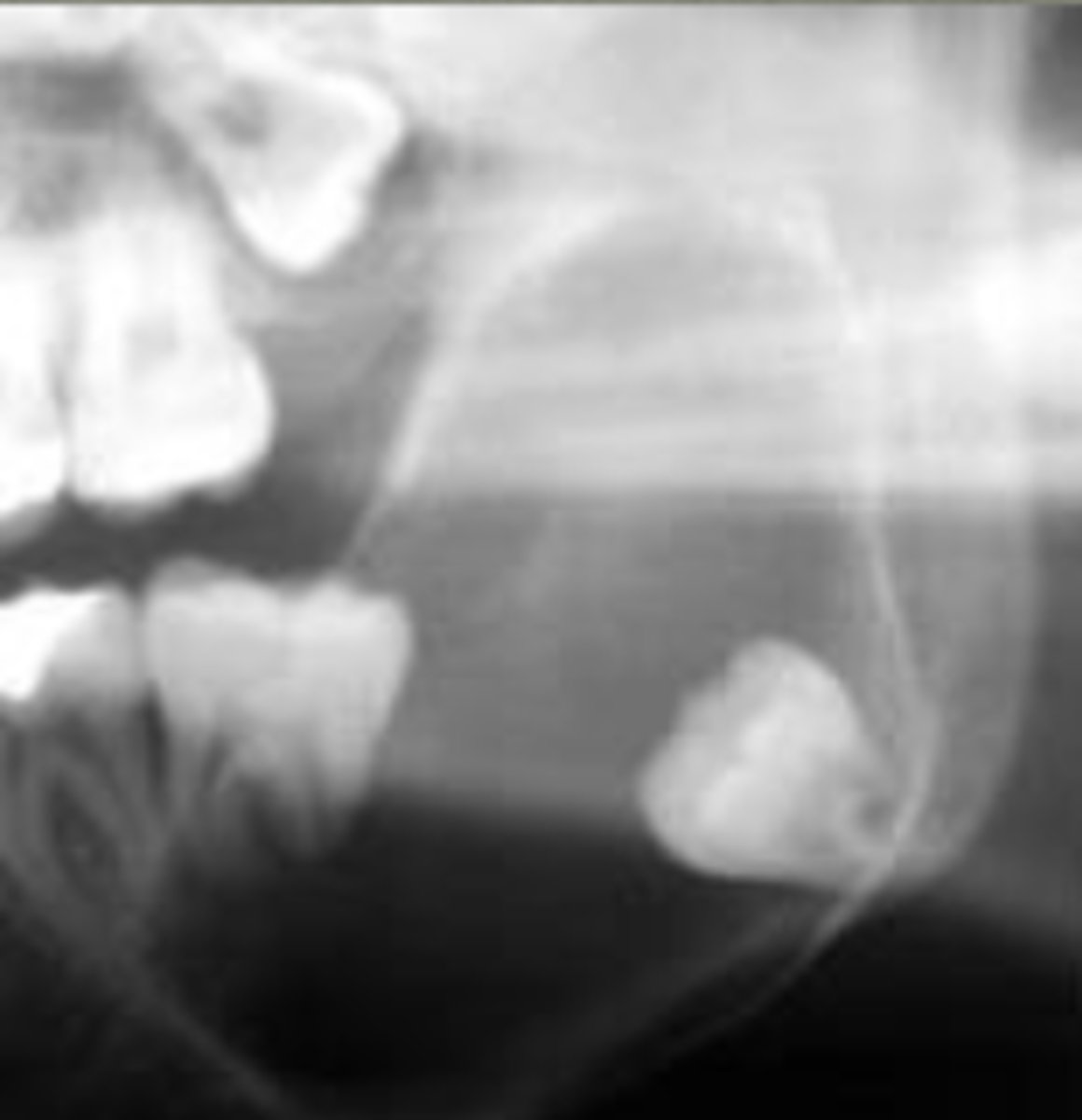 <p>unilocular radiolucency that often appears around 3rd molars</p>