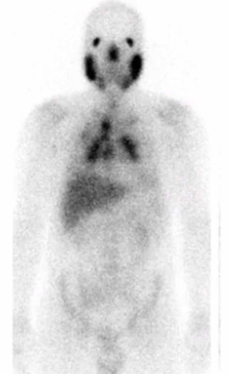 <p>uptake in the chest</p>