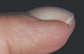 <p>bulbous swelling of soft tissue at base of nail, angle between nail and proximal fold &gt; 180 degrees</p>