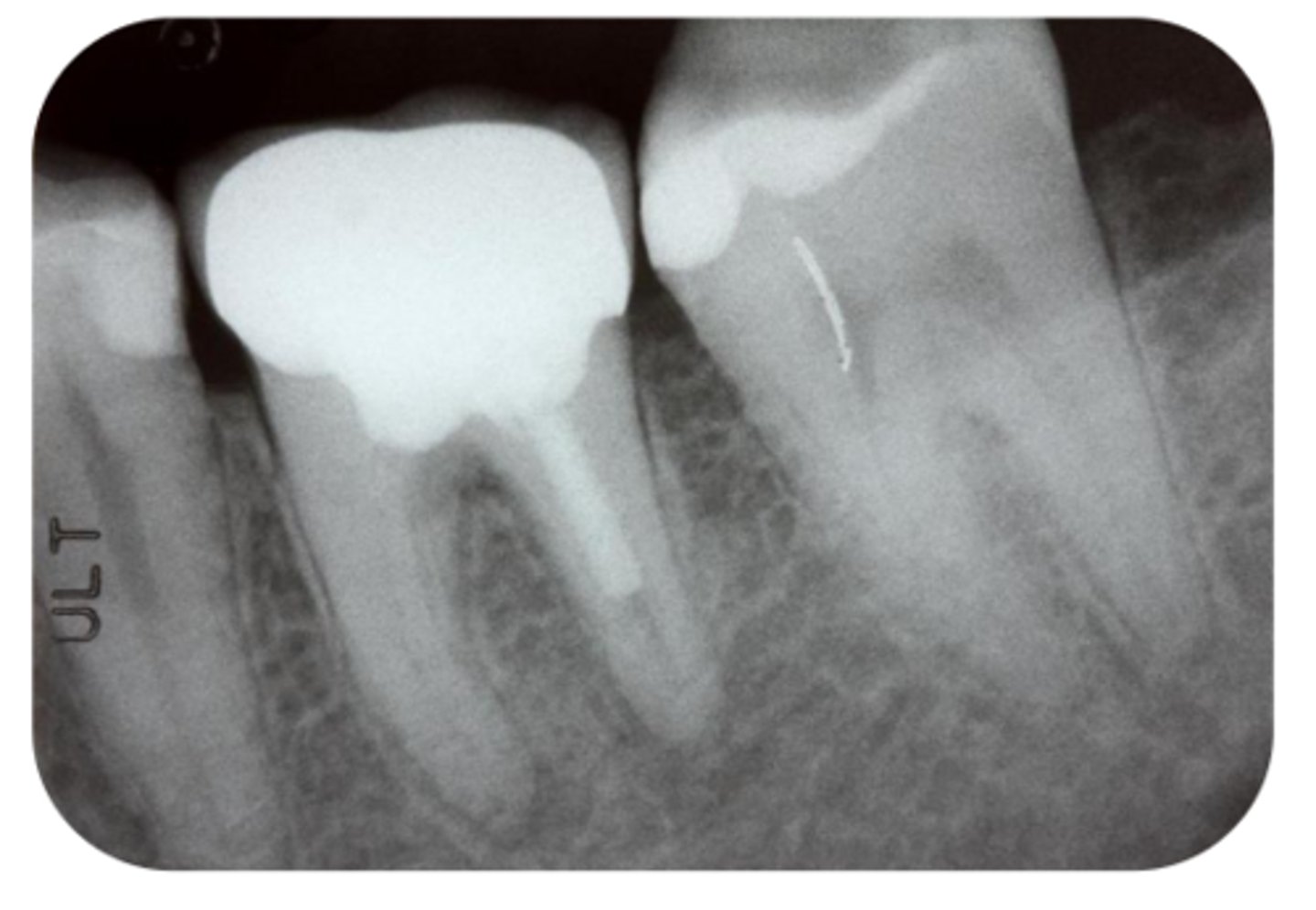 <p>What are the radiographic findings on #19?</p>