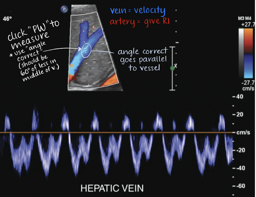 <ul><li><p>complex, <u>spontaneous</u>, <u>above and below baseline</u></p></li><li><p>variations with respiration cycle</p></li><li><p><u>hepatofugal</u></p></li></ul><p></p>
