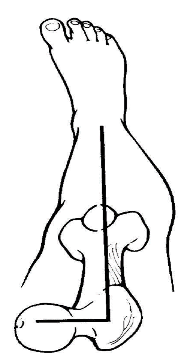 <p>the angle of femoral neck in the transverse plane is termed the </p><p>normally the femoral neck is rotated anteriorly 12-15 degrees with respect to the femur</p><p>the varus/valgus and the anteversion/retroversion position will also influence distal joints at the knee and the ankle</p>