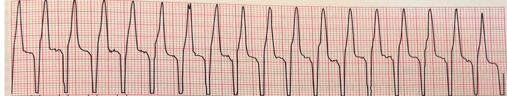 <p><span>The&nbsp;_______&nbsp;arrhythmia is fast and characterized by bizarre looking QRS complexes with no P or T wave. This arrhythmia can be treated with Lidocaine or beta blockers if the arrhythmia is stable. Please name the arrhythmia shown below.&nbsp;</span></p>