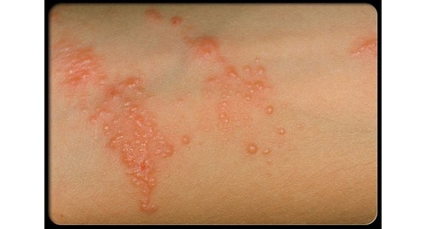 <p>Linear streaks of erythema, vesicles, and bullae 24-72 hours after exposure with intense pruritus</p>