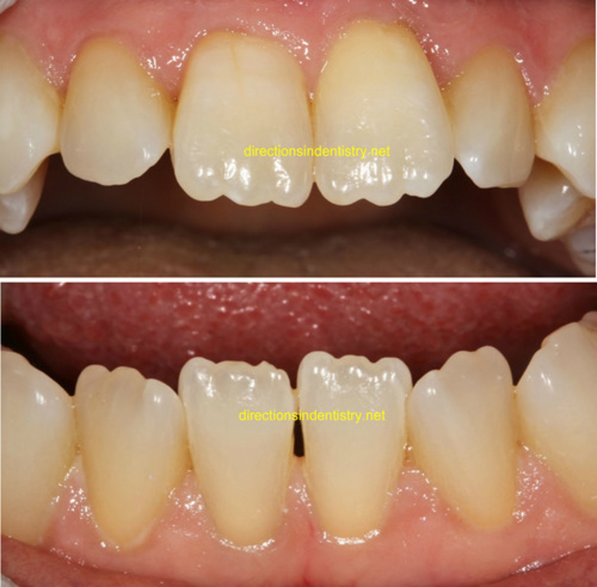 <p>three bulges on the incisal edge of a newly erupted central incisor</p>