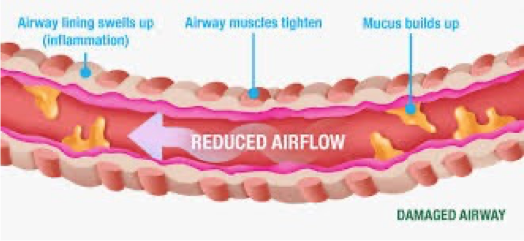 <p>Airway PathologyChronic Bronchitis</p>