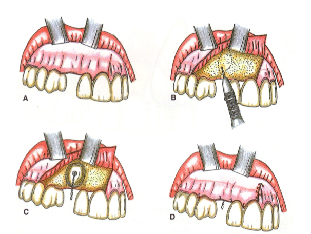 <p>Full thickness triangular flap&nbsp;</p><p>Cement orthodontic button, place ligature</p><p>Reposition flap and suture</p>