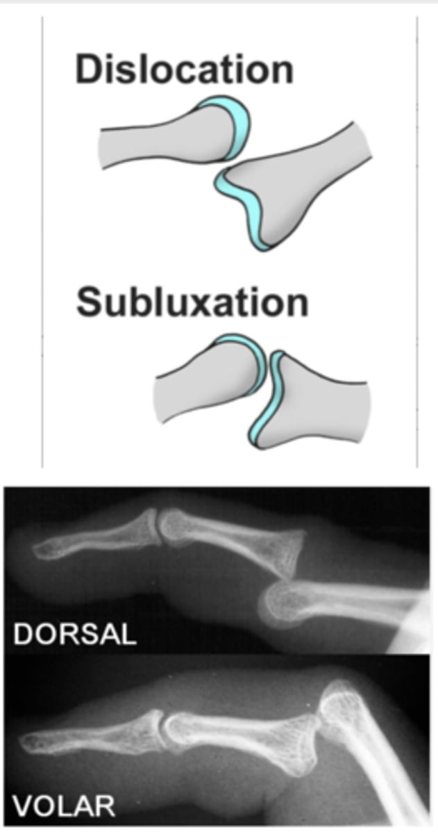 <p>-partial dislocation of a joint (volar or dorsal displacement of joints)</p><p>-S&amp;S: reduced range of motion, feeling of the joint being "out of place" or "slipping.</p><p>dorsal subluxation: the bone moves towards the back side</p><p>volar subluxation: the bone moves towards the palm or front side</p>