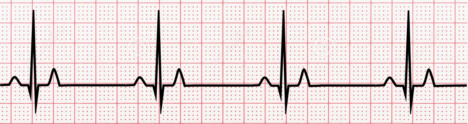 <p>name  ECG pattern</p>