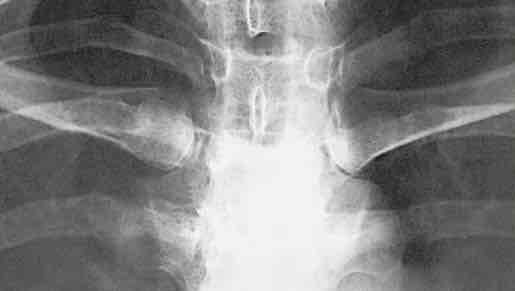 <p>What is this x-ray demonstrating?</p>