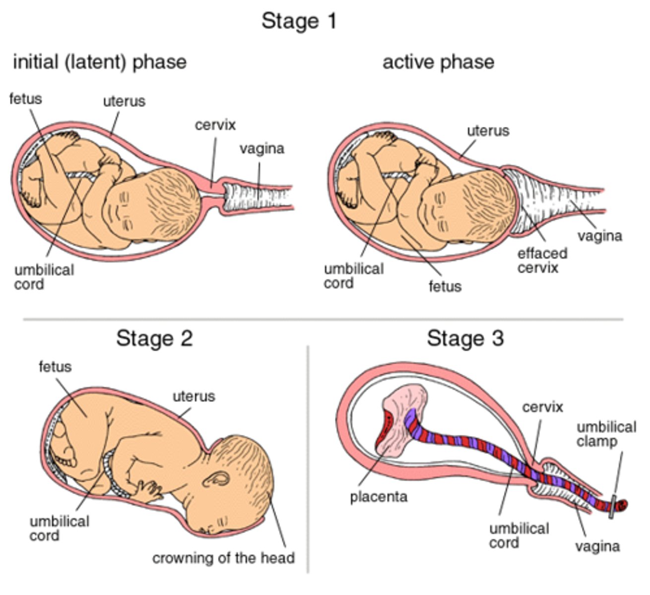 <p>a. Dilation stage, longest stage—lasting 8 to 24 hours</p><p>b. Dilation of cervical canal and effacement (thinning) of cervix to reach 10 cm, the diameter of fetal head</p><p>c. Rupture of fetal membranes and loss of amniotic fluid</p><p>-"Breaking of the waters"</p><p>d. Late dilation—dilation reaches 10 cm in 24 hours or less in primipara (first baby) and in as little as a few minutes in multipara</p>