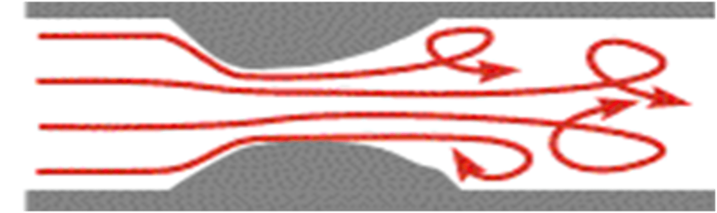 <p>flow disturbance post-stenosis demonstrating turbulent flow reversal and loss of energy due to inertia</p>