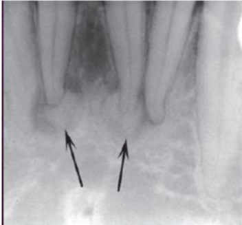 <p>describe this lesion </p>