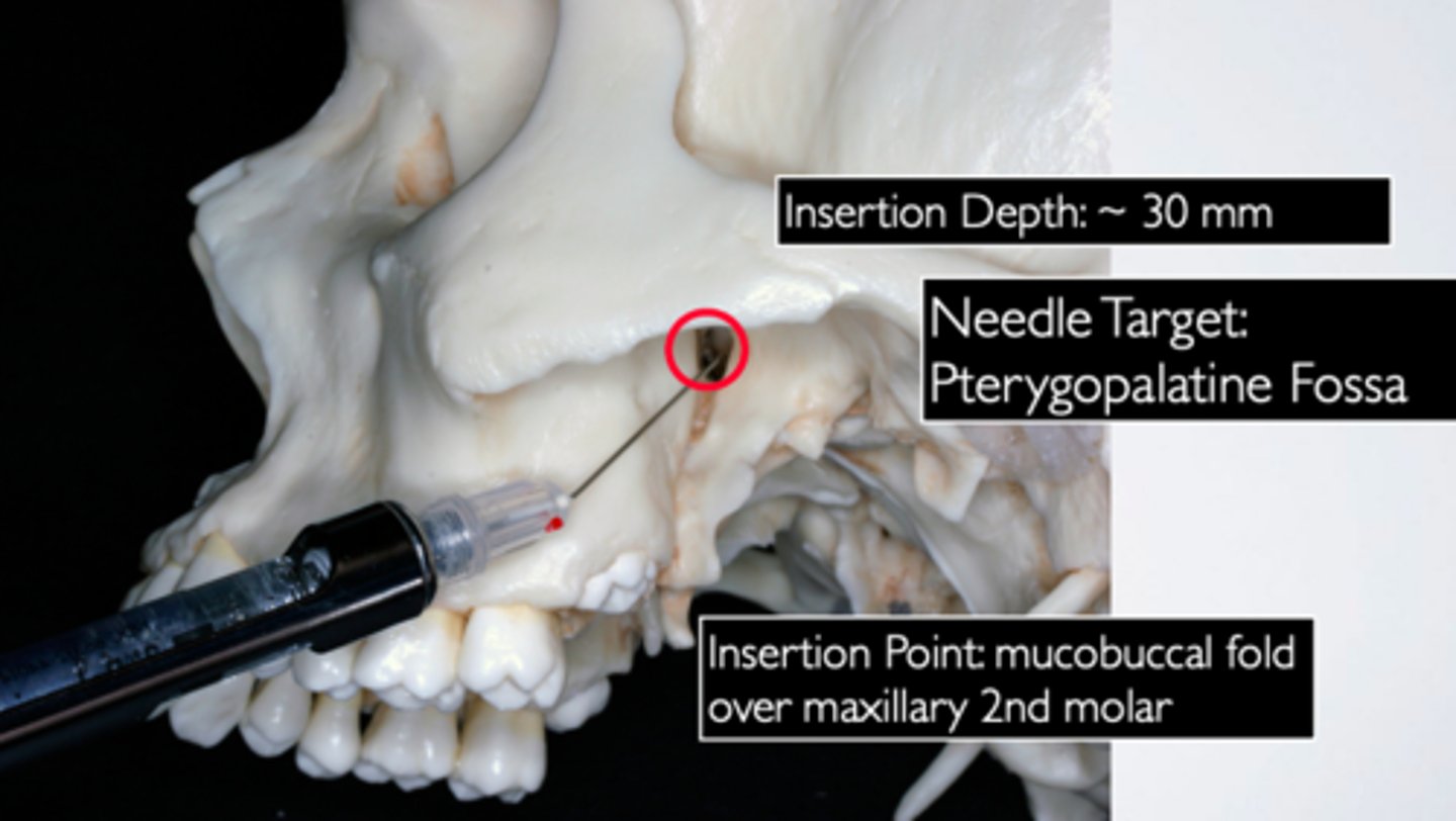 <p>ID the anesthesia technique:</p>