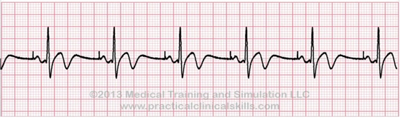 <p>What does this EKG represent?</p>