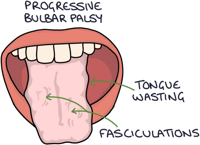 <p>What does PBP stand for?</p>
