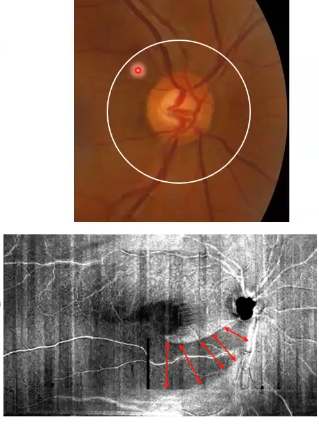 <p>why is cpRNFL scans useful</p>