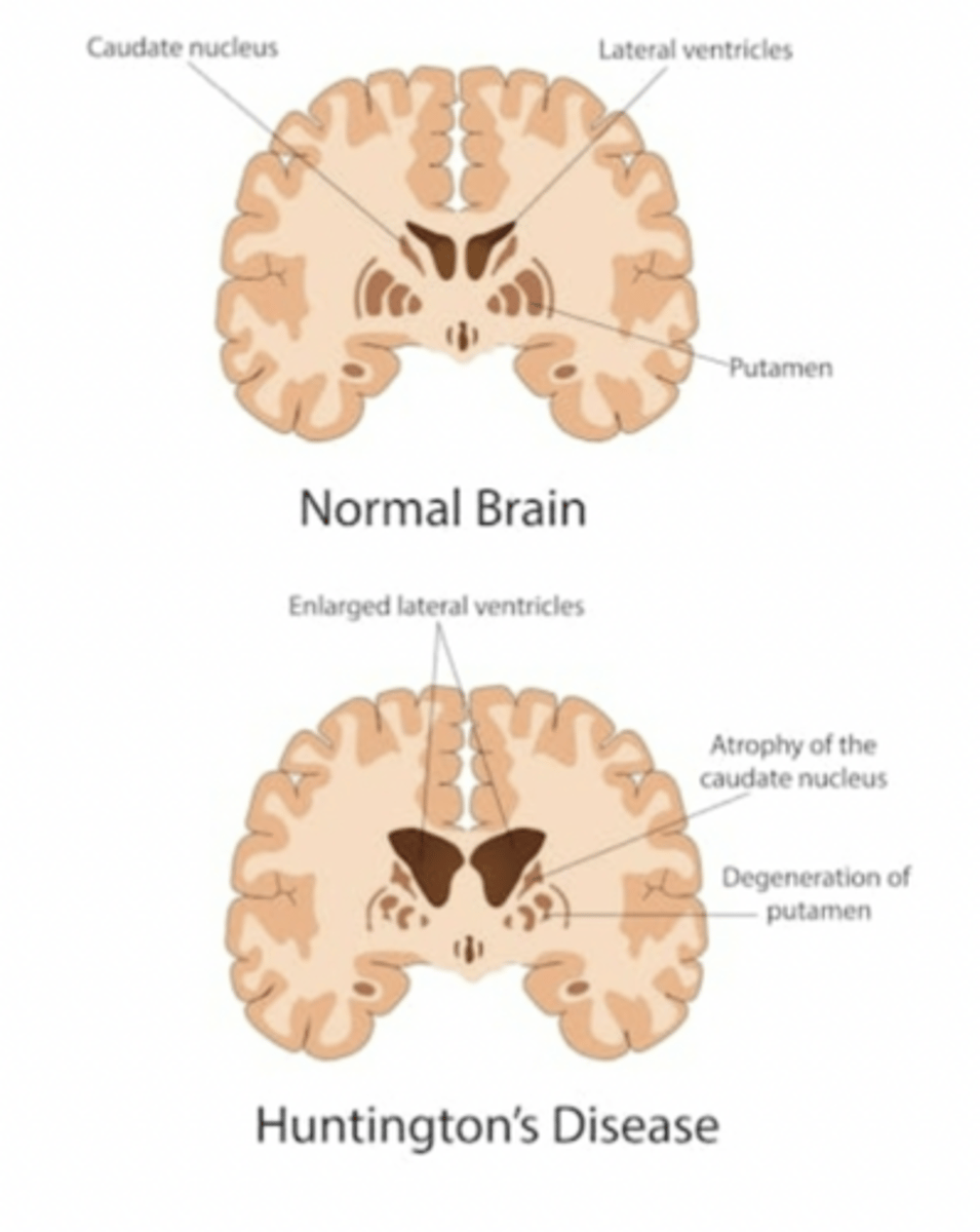 <p>A progressive, fatal, inherited genetic disorder that leads to involuntary movement and cognitive decline.</p>