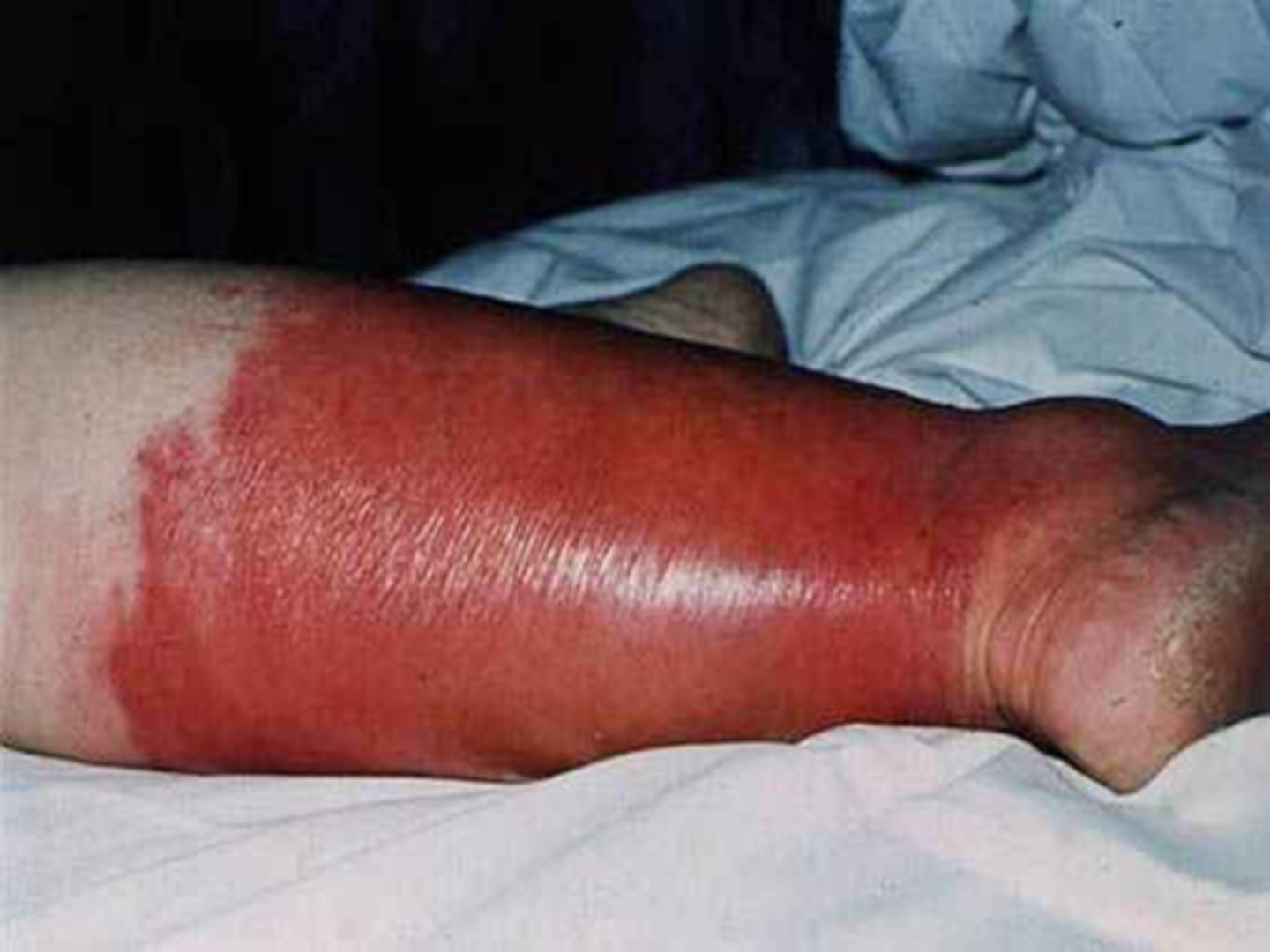 <p>PE: </p><p>Erythema, warmth, and edema of affected area</p><p>Painful, well-defined erythematous, shiny, edematous plaques </p>