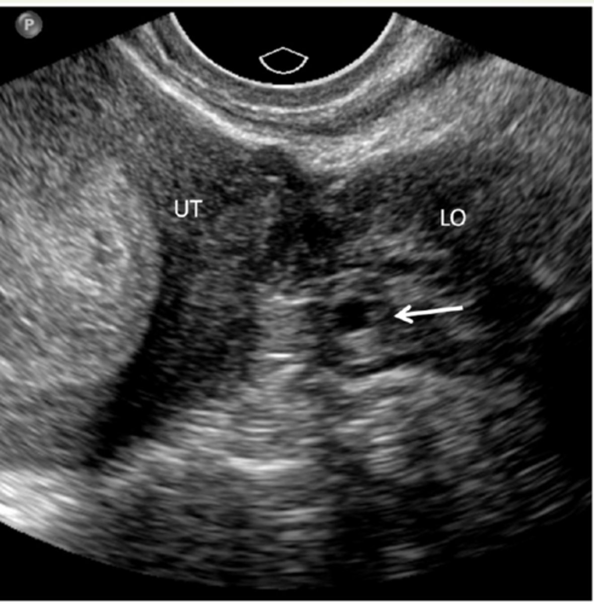 <p>Ectopic pregnancy</p>