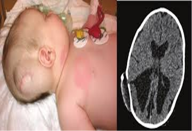 <p><span><span>Shunt</span></span></p><ul><li><p><span><span>Ventriculoperitoneal</span></span></p></li></ul><p></p><p><span><span>Drain</span></span></p>