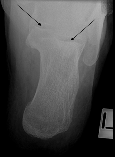 <ul><li><p>LA of calc // LA of IR</p></li><li><p>sustentaculum tali seen medially</p></li></ul><p></p><p>EXT.ROT</p><ul><li><p>4-5MT seen laterally</p></li><li><p>5MT almost free of SI</p></li><li><p>4MT coming into profile </p></li></ul><p>INT.ROT</p><ul><li><p>1MT seen medially</p></li></ul><p></p>