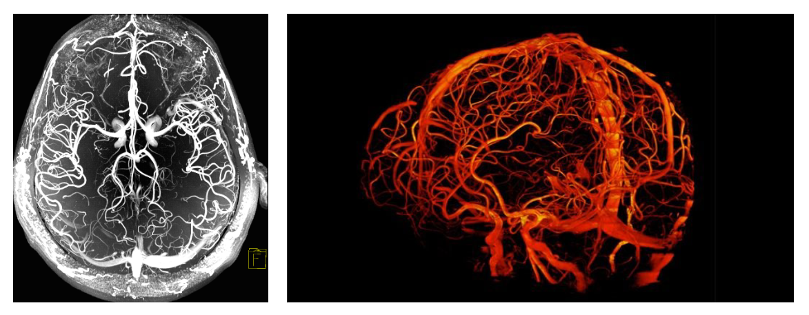 <p>Magnetic resonance <u>angio</u>graphy (MRA) = MRI focused on blood vessels.</p><ul><li><p>Image of the blood flow. </p></li></ul><p></p>