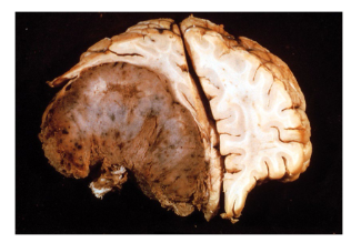 <p>What type of brain lesion is this?</p>
