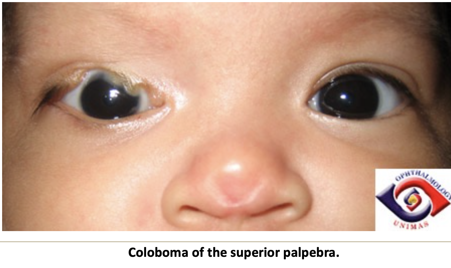 <p>A notch-like defect usually affecting the superior palpebra.</p>